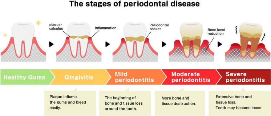 Verschillende stadia van parodontitis